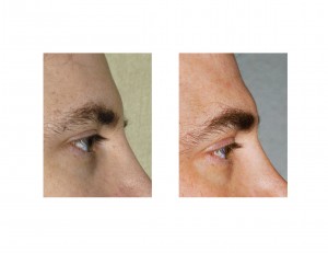 Brow Fat Injections Indianapolis Dr Barry Eppley