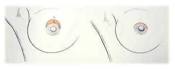 Nipple Lift (Superior Crescent Mastopexy) Dr Barry Eppley Indianapolis
