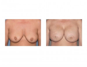 Nipple Lifts in Breast Augmentation front view Dr Barry Eppley Indianapolis (1)