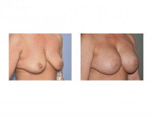 Nipple Lifts in Breast Augmentation oblique view Dr Barry Eppley Indianapolis