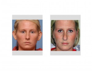 Otoplasty Results front view Dr Barry Eppley Indianapolis