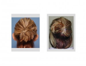 Otoplasty results back view Dr Barry Eppley Indianapolis