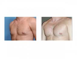 Pectoral Implant Augmentation Dr Barry Eppley Indianapolis