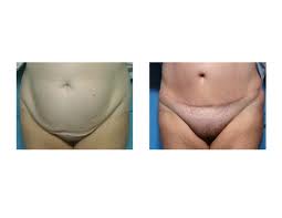 Tummy Tuck and Quality of Life Dr Barry Eppley Indianapolis