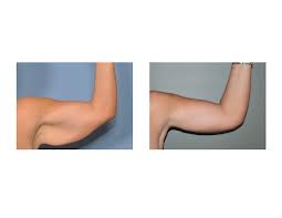 Armlift Surgery Dr. Barry Eppley Indianapolis