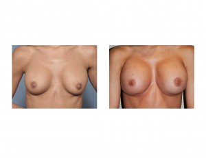 Breast Implant Replacement Dr Barry Eppley Indianapolis