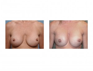 Breast Implant Replacement results front view Indianapolis Dr Barry Eppley
