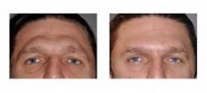 Brow Bone Reduction Dr Barry Eppley Indianapolis