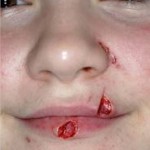 Facial Dogbites in Children Indianapolis Dr Barry Eppley