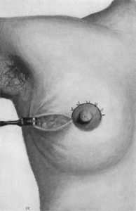 History of Breast Lift Surgery DDr Barry Eppley Indianapolis copy