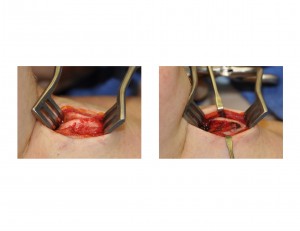 Tracheal Shave intraop Dr Barry Eppley Indianapolis