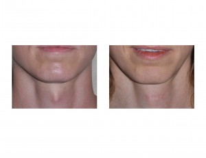 Tracheal Shave result front view Dr Barry Eppley Indianapolis