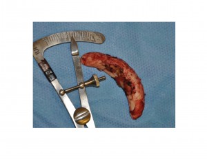 Vertical Chin Reduction intraop Dr Barry Eppley Indianapolis