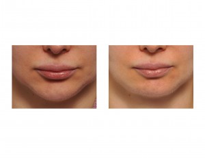 Vertical Chin Reduction result front view