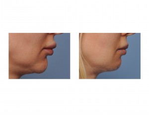 Vertical Chin Reduction result side view