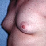 Younger Gynecomastia Reduction Dr Barry Eppley Indianapolis