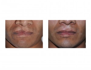 Adult Cleft Lip Repair Dr Barry Eppley Indianapolis
