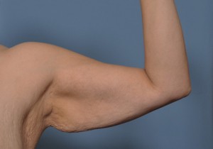 Armlift Surgery Indianapolis Dr Barry Eppley