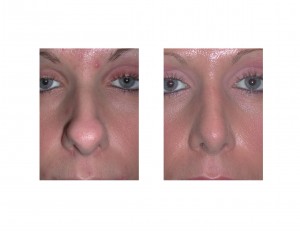 Boxy Nose Rhinoplasty Dr Barry Eppley Indianapolis