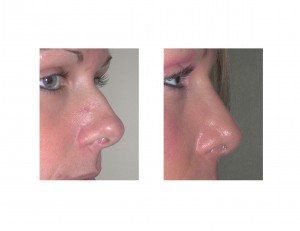 Boxy Nose Rhinoplasty resuly side view Dr Barry Eppley Indianapolis