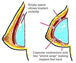 Breast Implant Capsular Contracture Dr Barry Eppley Indianapolis