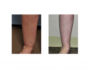 Cankle Liposuction Dr Barry Eppley Indianapolis