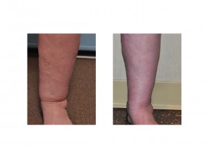 Cankle Liposuction Indianapolis Dr Barry Eppley