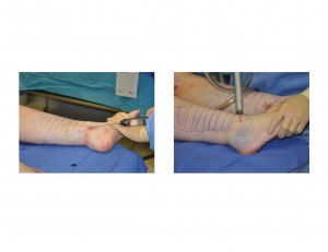 Cankle Liposuction technique Dr Barry Eppley Indianapolis