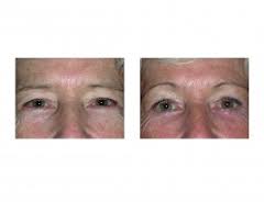 Endoscopic Browlift Dr Barry Eppley Indianapolis