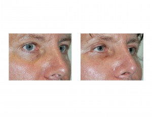 Infraorbital rim implant result dr barry eppley indianapolis