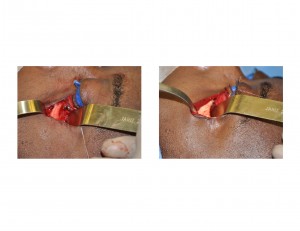 Orbital Asymmetry Correction intraop Dr Barry Eppley Indianapolis