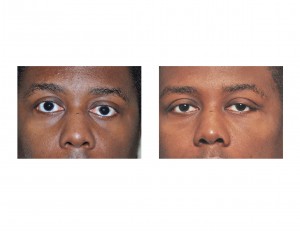 Orbital Asymmetry Correction result Dr Barry Eppley