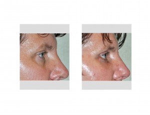 Orbital Rim Implants result side view Dr Barry Eppley Indianapolis