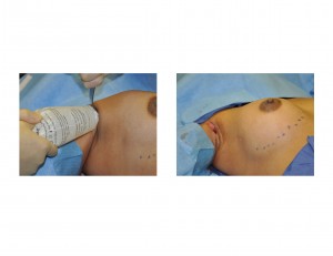 Transaxillary Funnel Breast Augmentation intraop Dr Barry Eppley Indianapolis