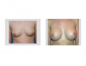 Transaxillary Funnel Breast Augmentation result front view Dr Barry Eppley Indianapolis