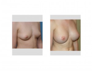 Transaxillary Funnel Breast Augmentation result oblique view Dr Barry Eppley Indianapolis