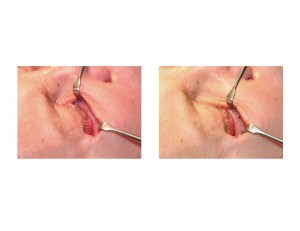 infraorbital rim implants intraop views