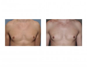 Areolar Gynecomastia Reduction results front Dr Barry Eppley Indianapolis