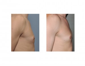 Areolar Gynecomastia Reduction results side view Dr Barry Eppley Indianapolis