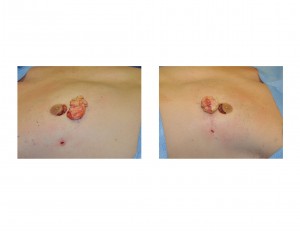 Areolar gynecomastia Excision Dr Barry Eppley Indianapolis