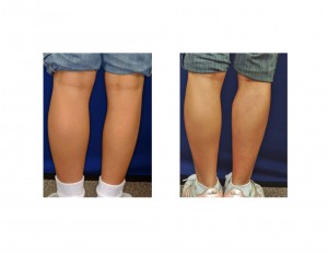 Calf Implant in Clubfoot back view Dr Barry Eppley Indianapolis