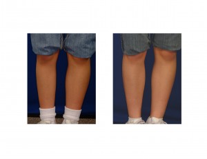 Calf Implant in Clubfoot front view Dr Barry Eppley Indianapolis