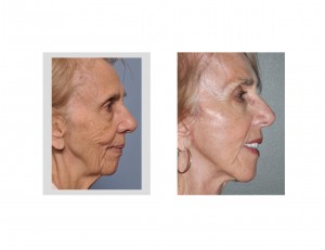 Facelift with Chin result side view Dr Barry Eppley Indianapolis