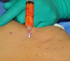 Fat injections Buttocks Indianapolis Dr Barry Eppely