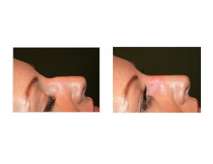 Injectable Rhinoplasty with Radiesse Dr Barry Eppley Indianapolis