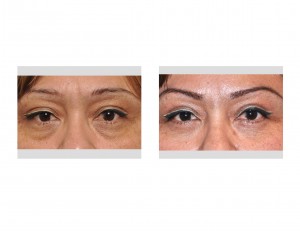 Lower Eyebag Removal in Females Dr Barry Eppley Indianapolis front view