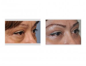 Lower Eyebag Removal in Females Dr Barry Eppley oblique view