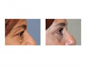 MJW Blepharoplasty result side view