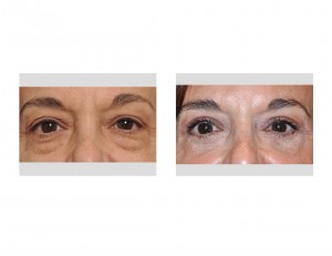 MJW Blepharoplasty results front view