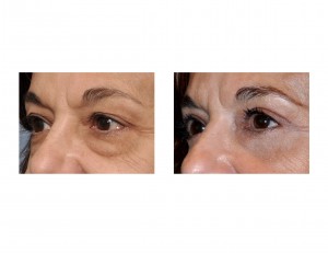 MJW Blepharoplasty results left oblique view